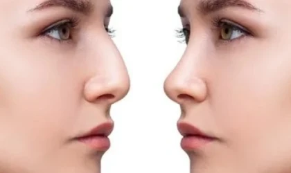 BURUN ESTETİĞİ İLE İLGİLİ EN ÇOK MERAK EDİLEN 12 SORU!